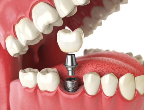 Navigating Dental Implant Options: Your Guide to Smiling