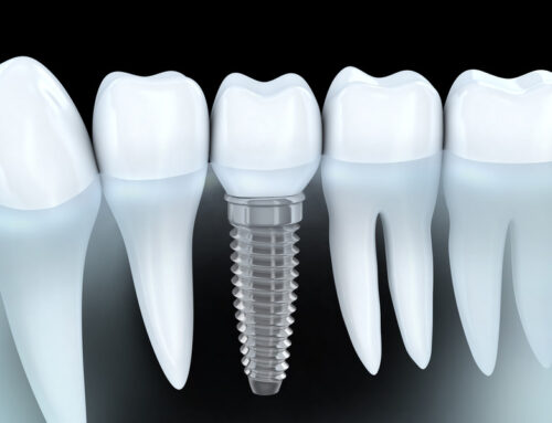 Dental Implants: Cavity-Free Tooth Replacement Solution